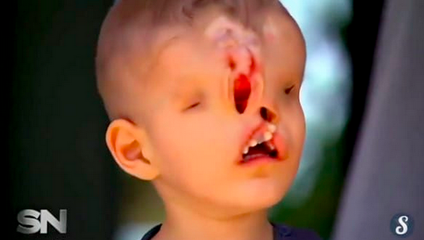 surgery-for-boy1
