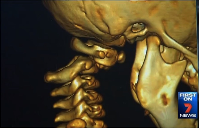 mj-godupdates-toddler-survives-miracle-surgery-after-decapitation-21