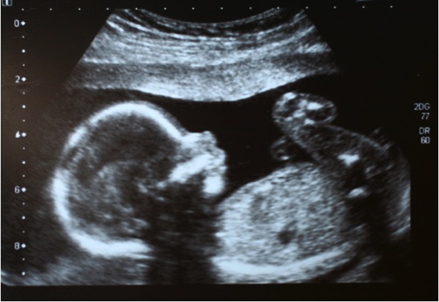 mj-godupdates-mom-sees-ultrasound-and-leaves-abortion-clinic-21