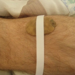 Potato-on-Leg-with-Tape-2-300x3001